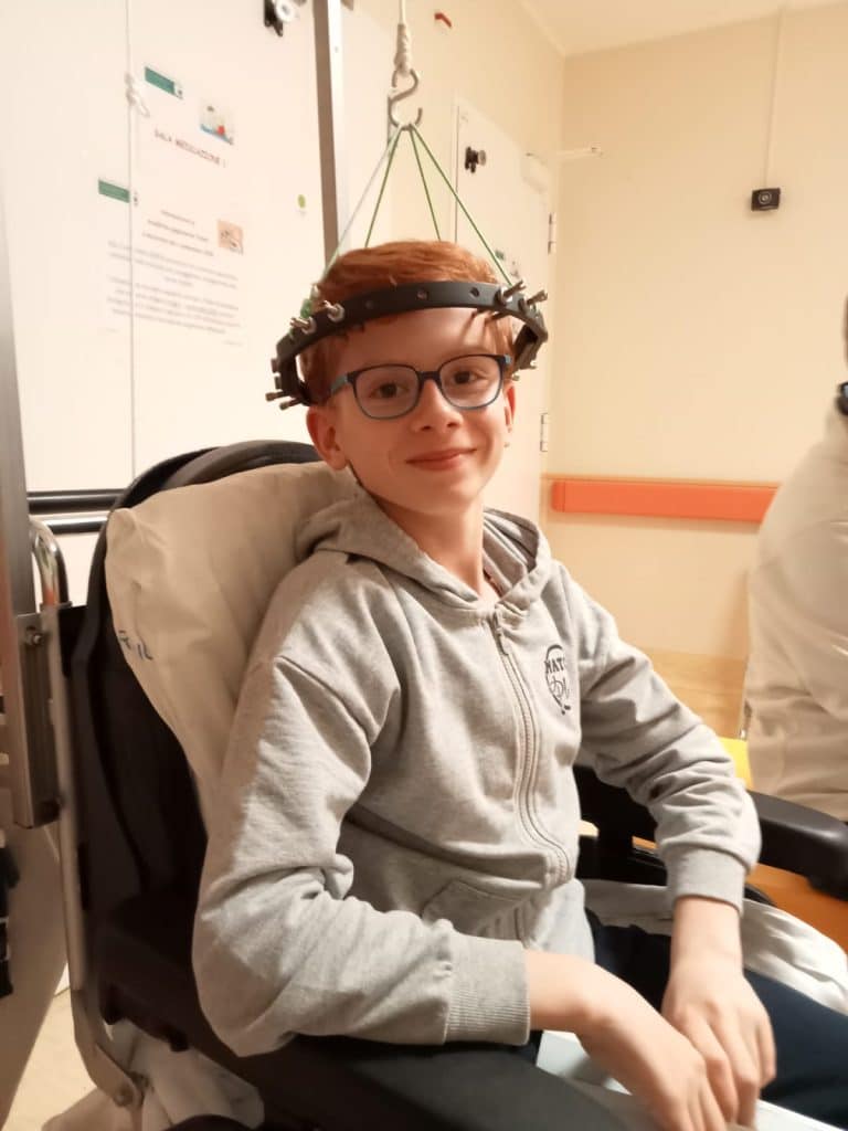 Gabriele bambino chirurgico in trazione Halo all'Opsedale Burlo di Trieste